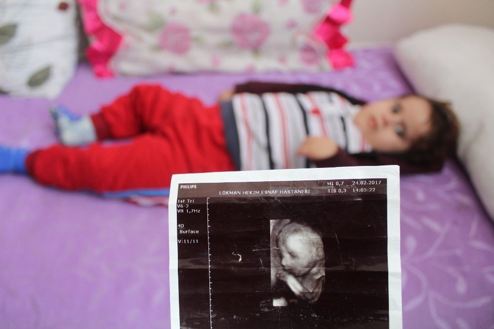 Antalya'da İki Bebeklerini Kaybeden Aile Üçüncü Bebekleri İçin ’Hidrosef 3