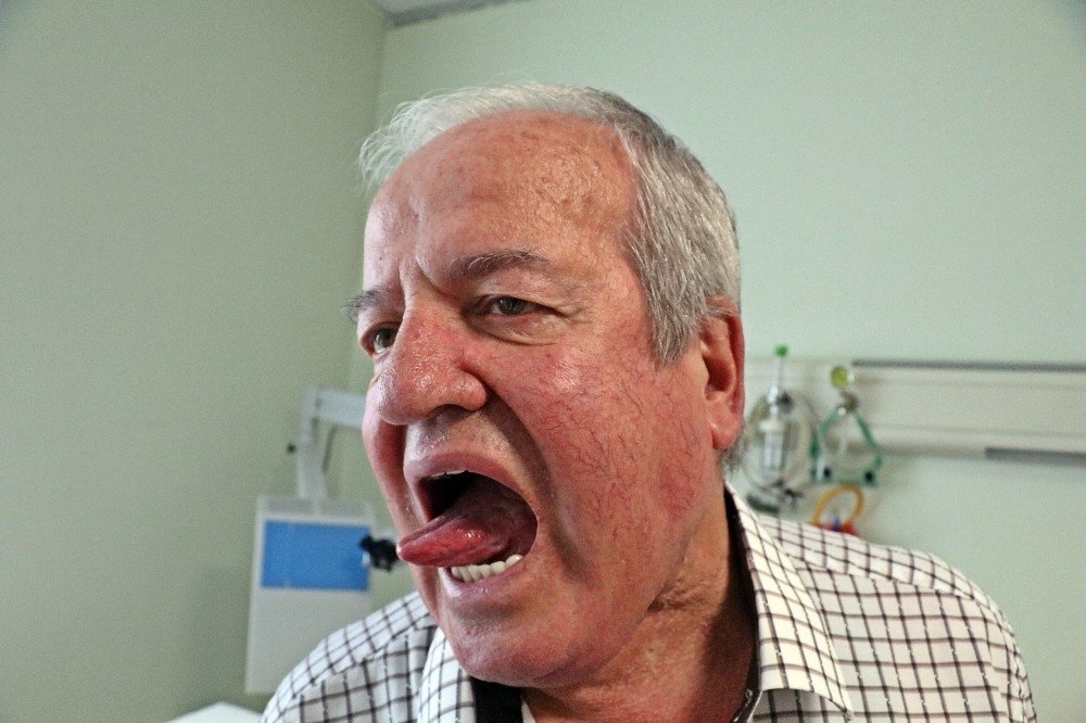 Çok Sevdiği Acı, Dilini Yakınca Kanser Olduğunu Öğrendi 2