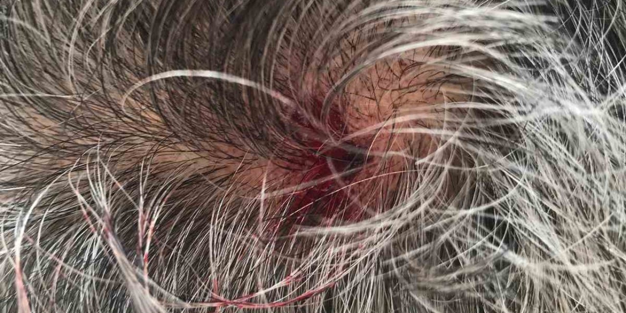 Ceviz Büyüklüğündeki Dolu Vatandaşın Kafasını Yardı