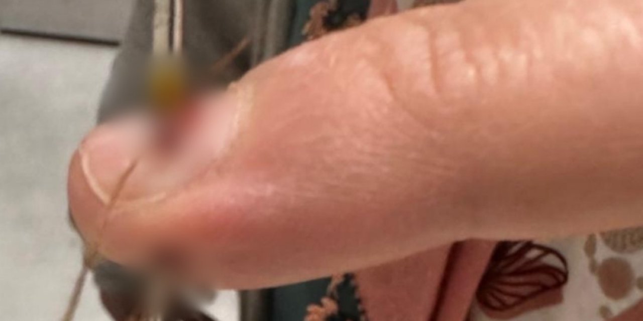 Eline Dikiş İğnesi Saplanan Kadın Hastanelik Oldu