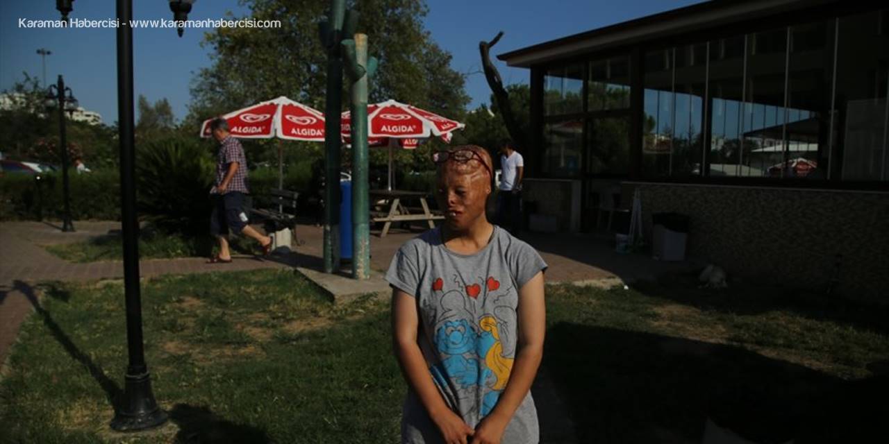 "Yüzüm Yanık Diye Herkes Benden Kaçıyor"