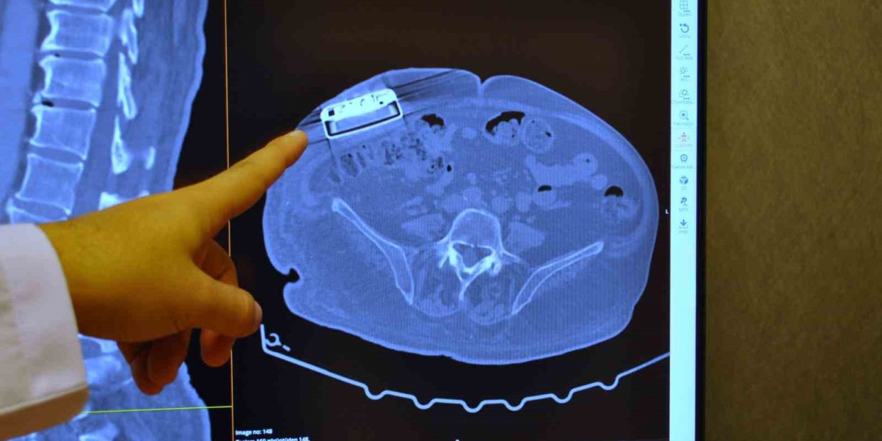 Gelişmiş Teknoloji Yeni Versiyon Baklofen Pompası Türkiye’de İlk Defa Eskişehir’de İmplante Edildi