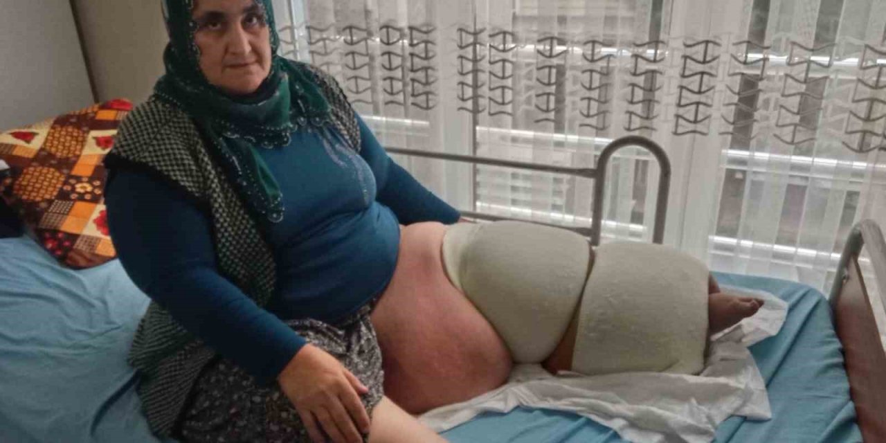 Fil Hastalığı Bacağını 100 Kilo Yaptı, Tedavisinin Devamı İçin Destek Bekliyor