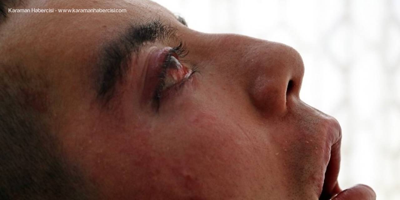 5 Yıldır Gözlerini Kırpamıyor, Adeta Kan Ağlıyor