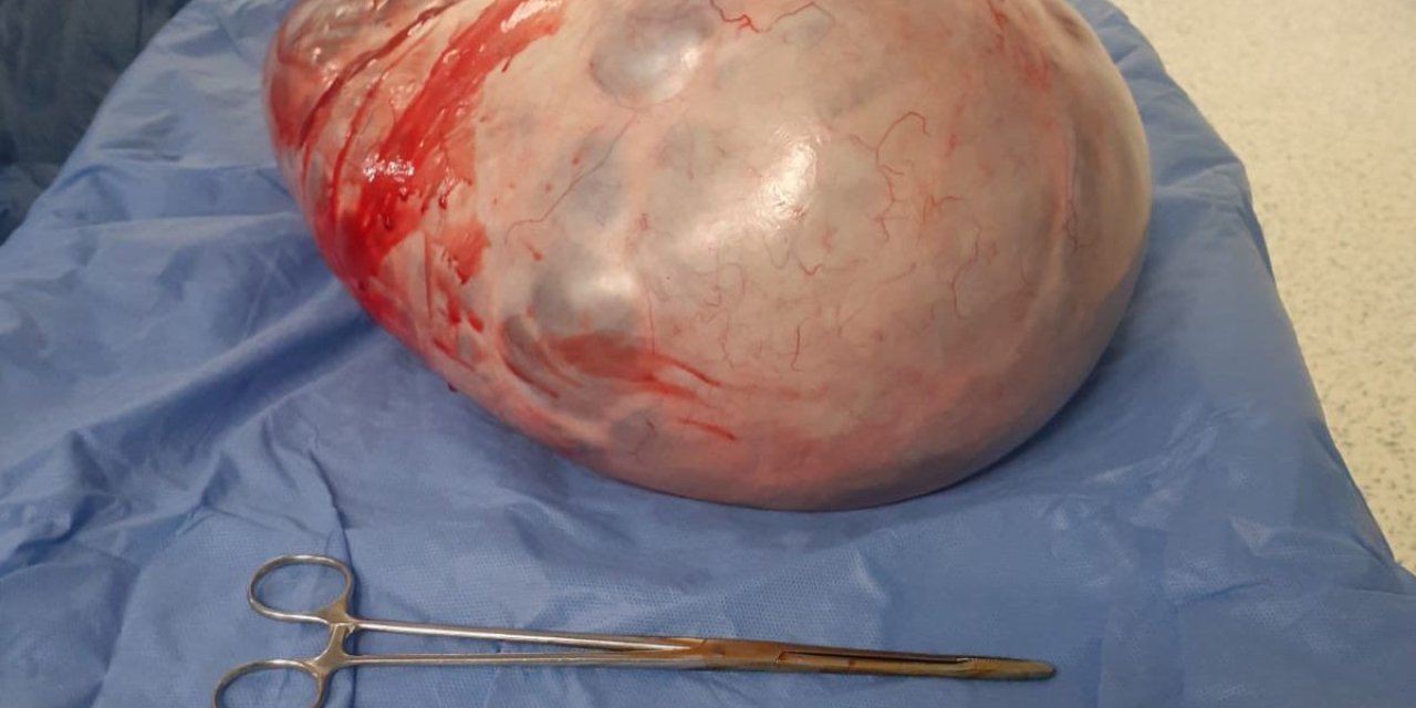 Karnından 9 Kilo Tümör Çıktı