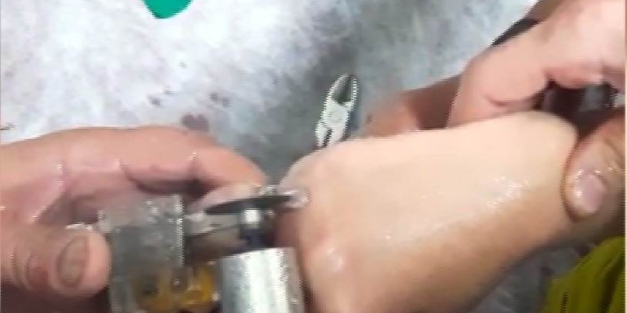Parmağı Kangren Olmadan Kurtardılar