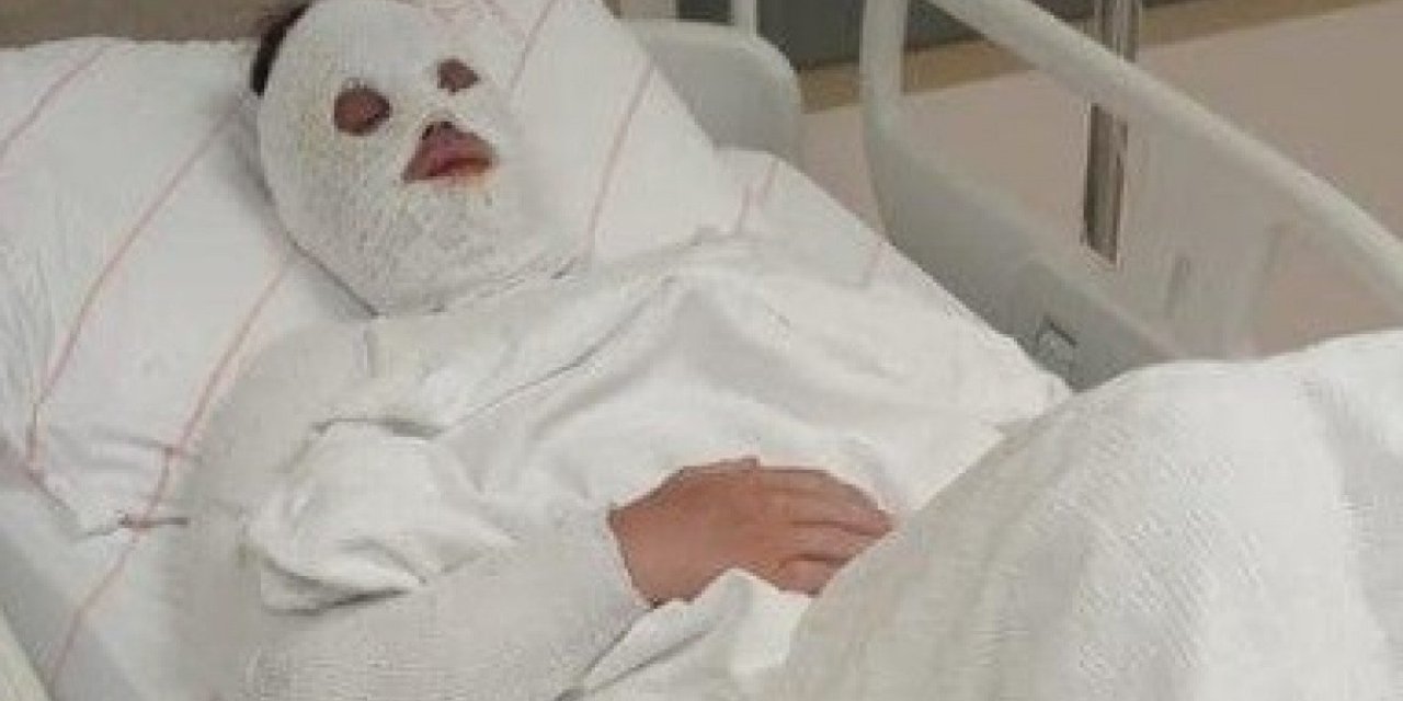 Eski Nişanlısına Kimyasal Sıvı Atan Kişinin İddianamesi Kabul Edildi