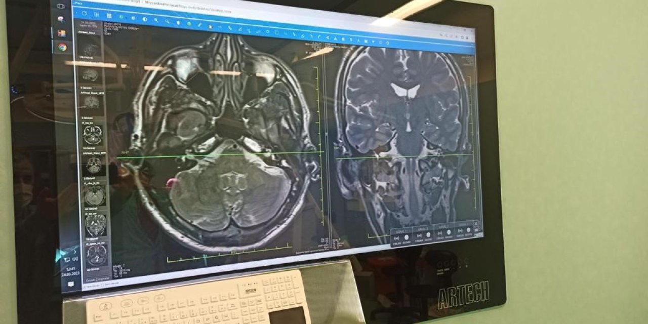 Eskişehir Şehir Hastanesinde İlk Yüz Felci Ameliyatı Gerçekleştirildi