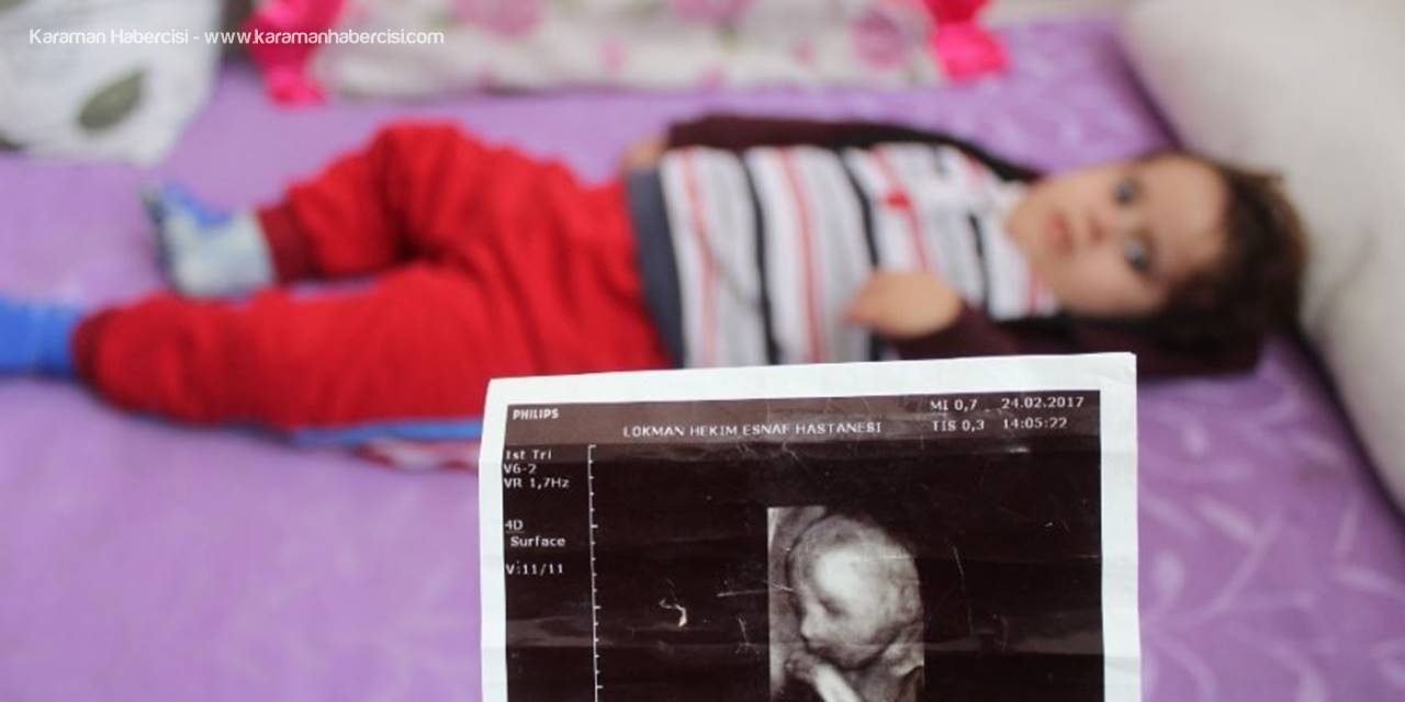 Antalya'da İki Bebeklerini Kaybeden Aile Üçüncü Bebekleri İçin ’Hidrosefali’ İle Mücadele Veriyor