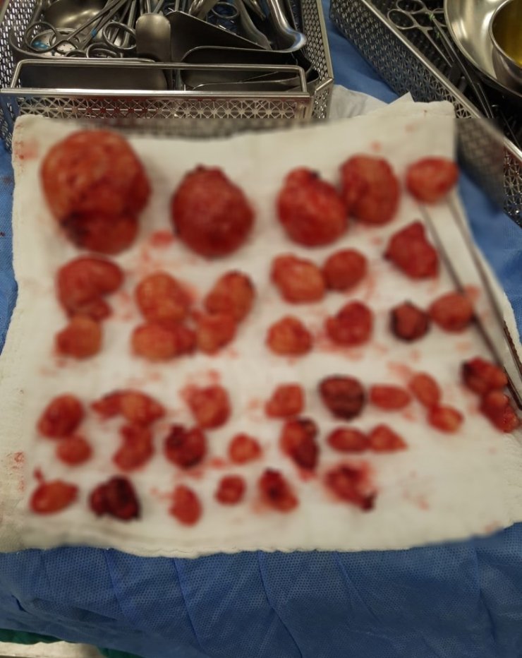 Karın Ağrısı İle Gitti Ur Çıktı