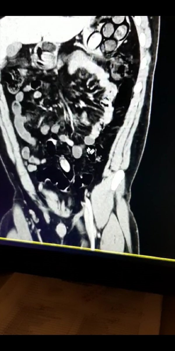 Midesinden Ve Bağırsağından 45 Kapsül Eroin Çıktı