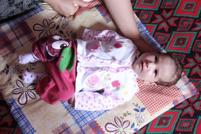 Ölümü Bekleyen Asel Bebek İçin Umut Işığı Doğdu