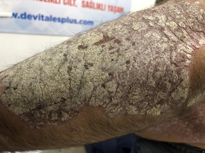 Tüm Vücudunu Sedef Saran Hasta Derdine Ankara’da Çare Arıyor