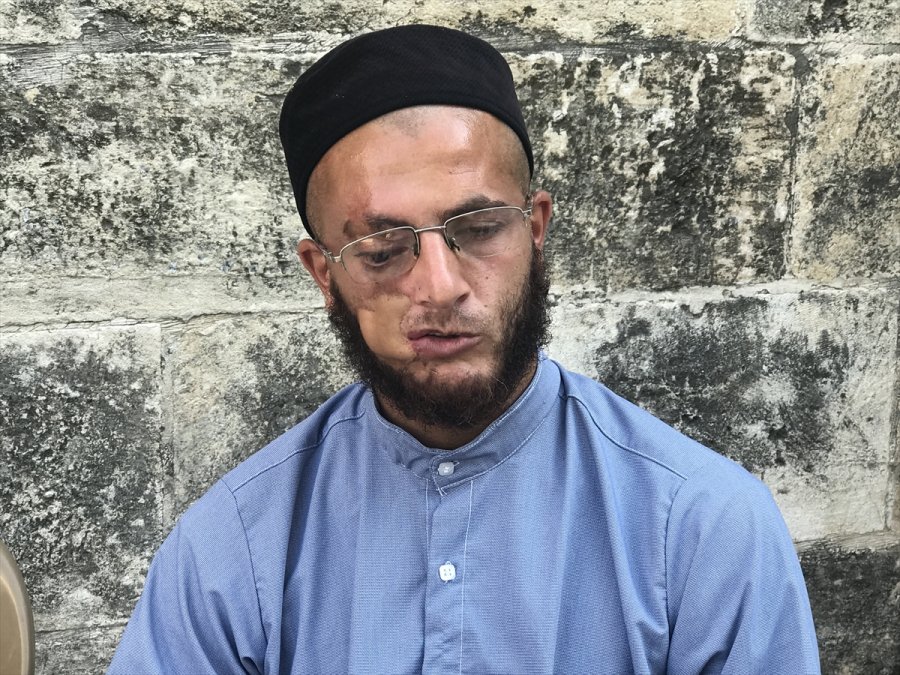 Yüzündeki Yara İzlerinden Kurtulup Çalışmak İstiyor