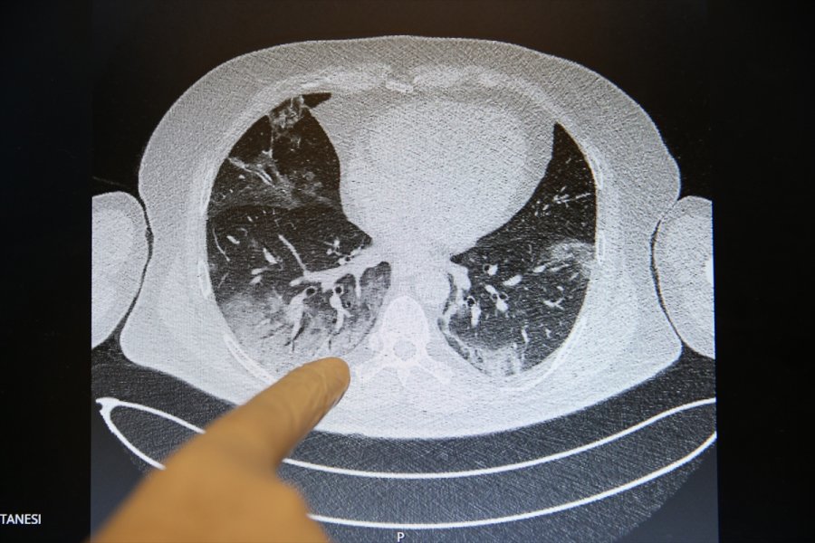 Kovid-19'un Akciğerlere Verdiği Zarar Tomografi Görüntülerine Yansıyor
