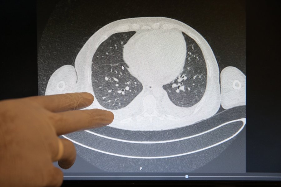Kovid-19'un Akciğerlere Verdiği Zarar Tomografi Görüntülerine Yansıyor