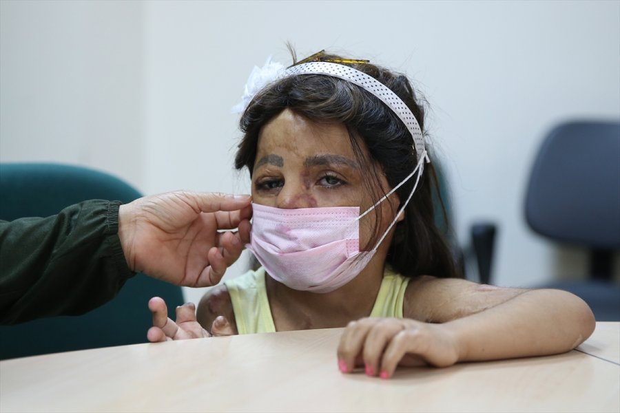 Suriyeli Küçük Hane'nin Yüzü Doku Nakliyle Güldü