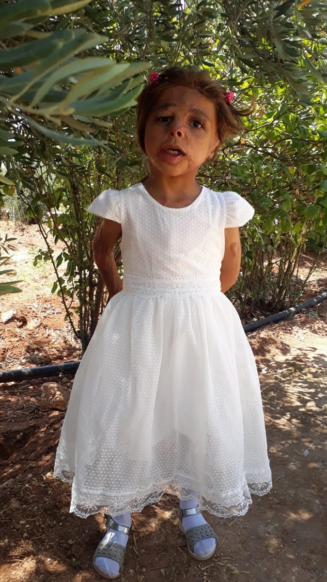 Suriyeli Küçük Hane'nin Yüzü Doku Nakliyle Güldü