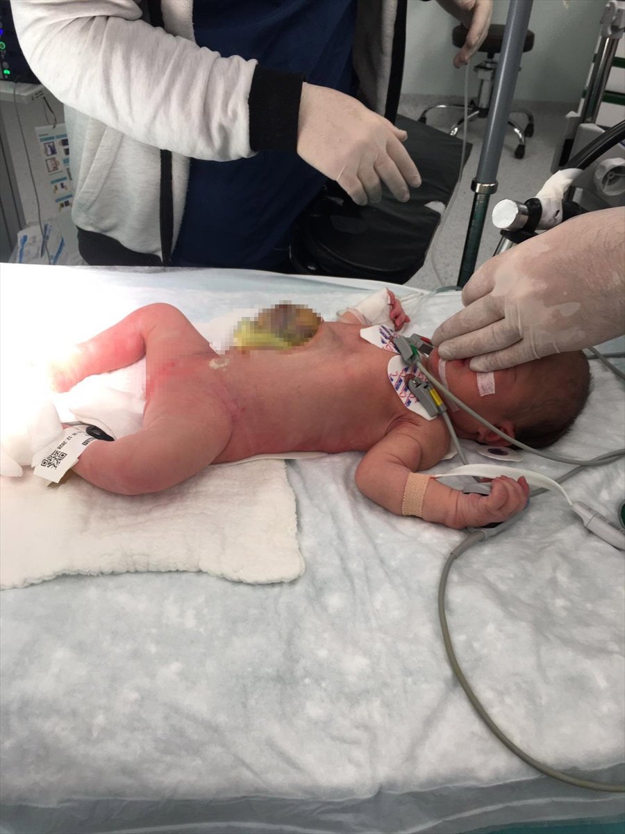 Mersin'de Karaciğer Ve Bağırsağı Dışarıda Doğan Miray Bebek Sağlığına Kavuştu
