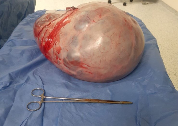 Karnından 9 Kilo Tümör Çıktı