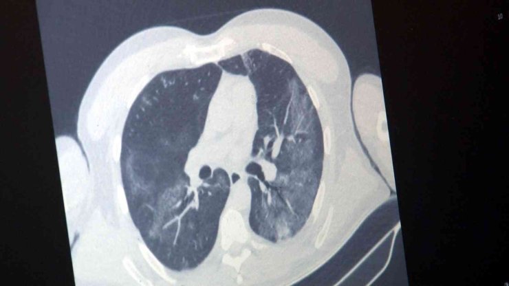 ’influenza’ Alarmı