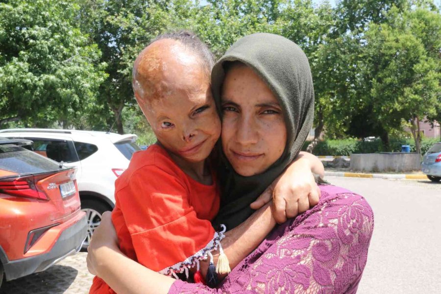 Yangında Yüzü Yanan Dilara’nın Annesi: “allah Razı Olsun Sağlık Bakanlığından, Kızımın Ameliyatını Karşılıyor”