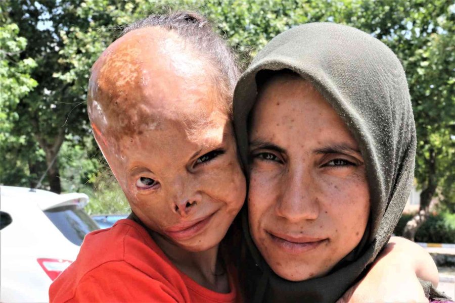 Yangında Yüzü Yanan Dilara’nın Annesi: “allah Razı Olsun Sağlık Bakanlığından, Kızımın Ameliyatını Karşılıyor”