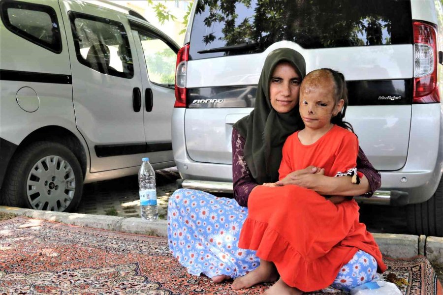 Yangında Yüzü Yanan Dilara’nın Annesi: “allah Razı Olsun Sağlık Bakanlığından, Kızımın Ameliyatını Karşılıyor”