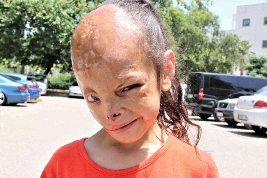 Yangında Yüzü Yanan Dilara’nın Annesi: “allah Razı Olsun Sağlık Bakanlığından, Kızımın Ameliyatını Karşılıyor”