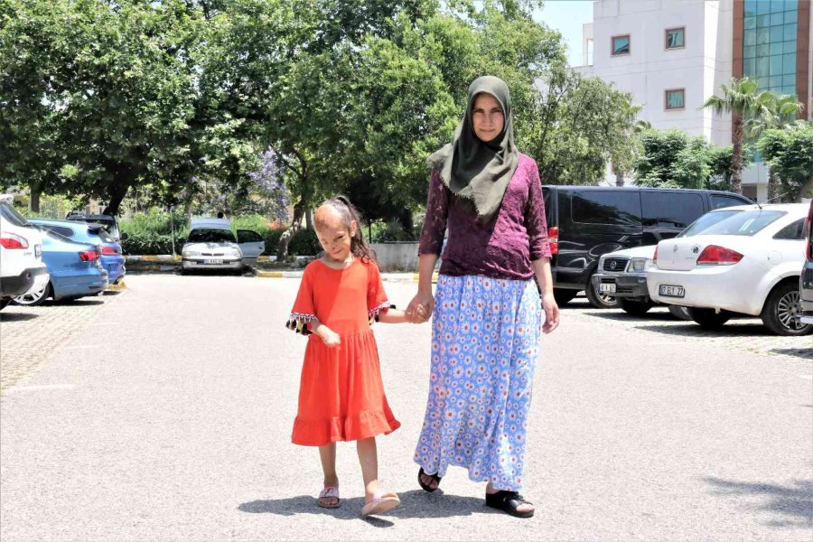 Yangında Yüzü Yanan Dilara’nın Annesi: “allah Razı Olsun Sağlık Bakanlığından, Kızımın Ameliyatını Karşılıyor”