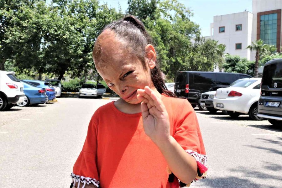 Yangında Yüzü Yanan Dilara’nın Annesi: “allah Razı Olsun Sağlık Bakanlığından, Kızımın Ameliyatını Karşılıyor”