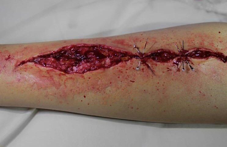 Bu Yaralar Gerçekten Farksız