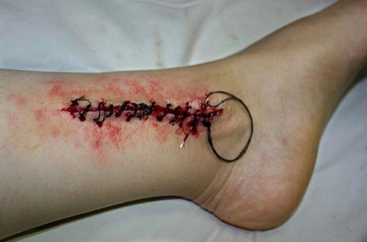 Bu Yaralar Gerçekten Farksız