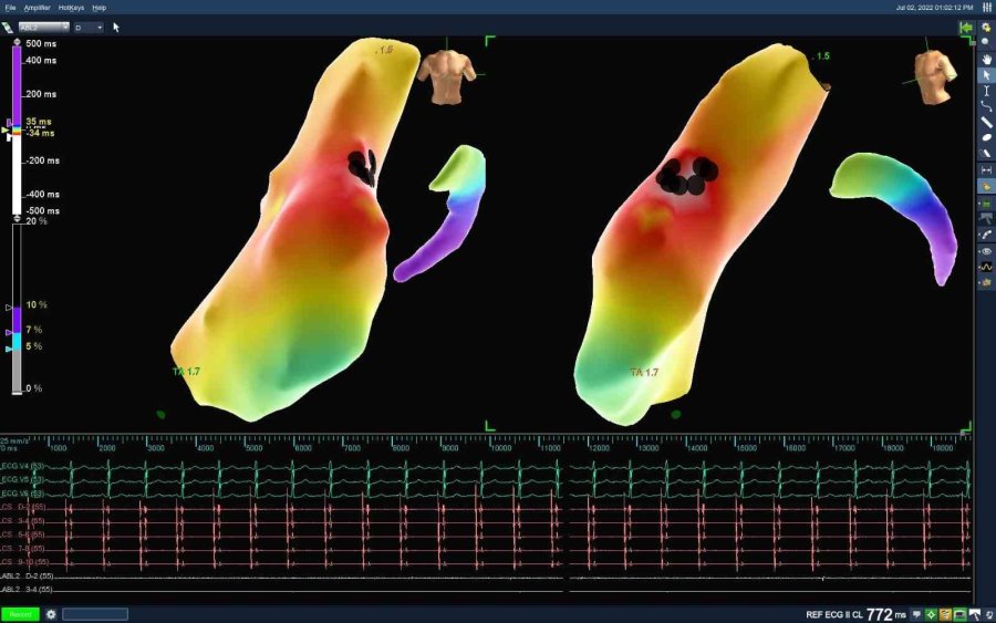 70 Yaşındaki Hasta Bu Yöntemle Sağlığına Kavuştu