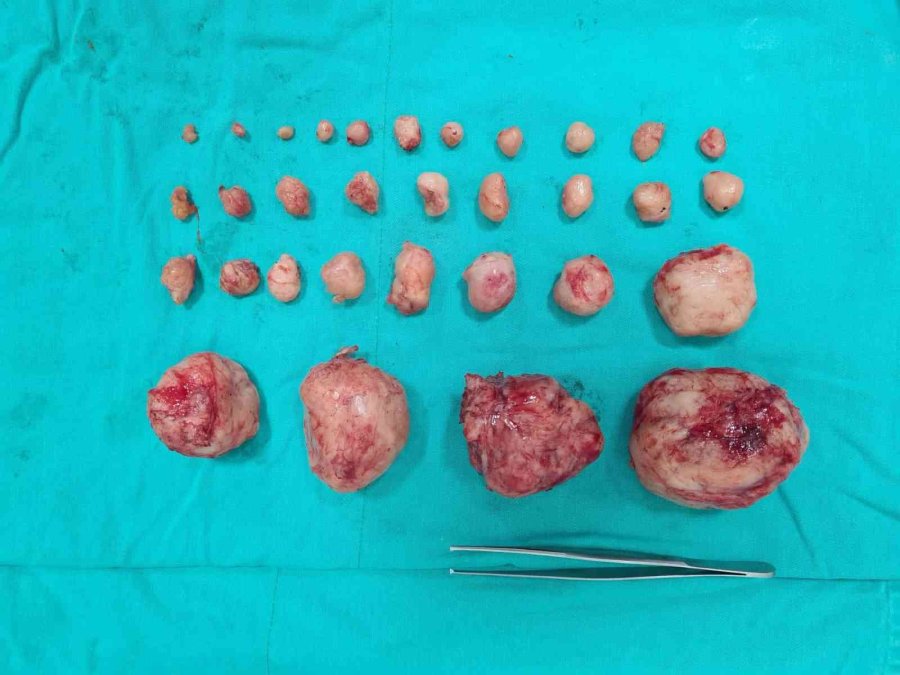 Hastanın Rahminden 32 Miyom Çıkartıldı