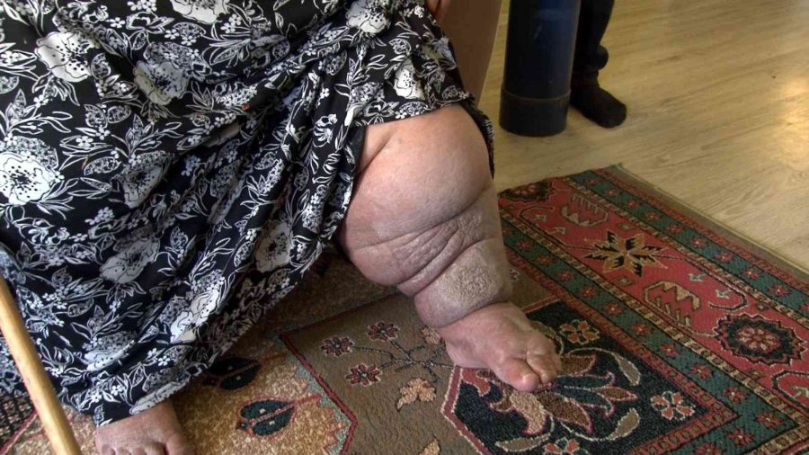 Babası Vefat Eden Hasan Fil Hastası Olan Annesi İle Yaşam Mücadelesi Veriyor