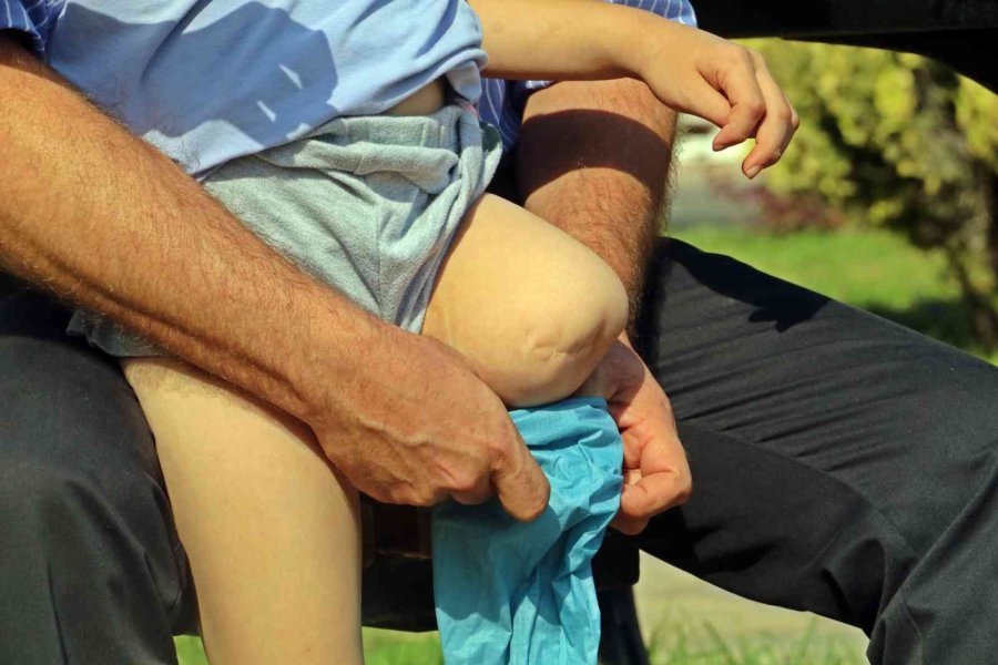 Koşmayı Beklerken Dar Gelen Proteziyle Yürümekte Zorlanıyor