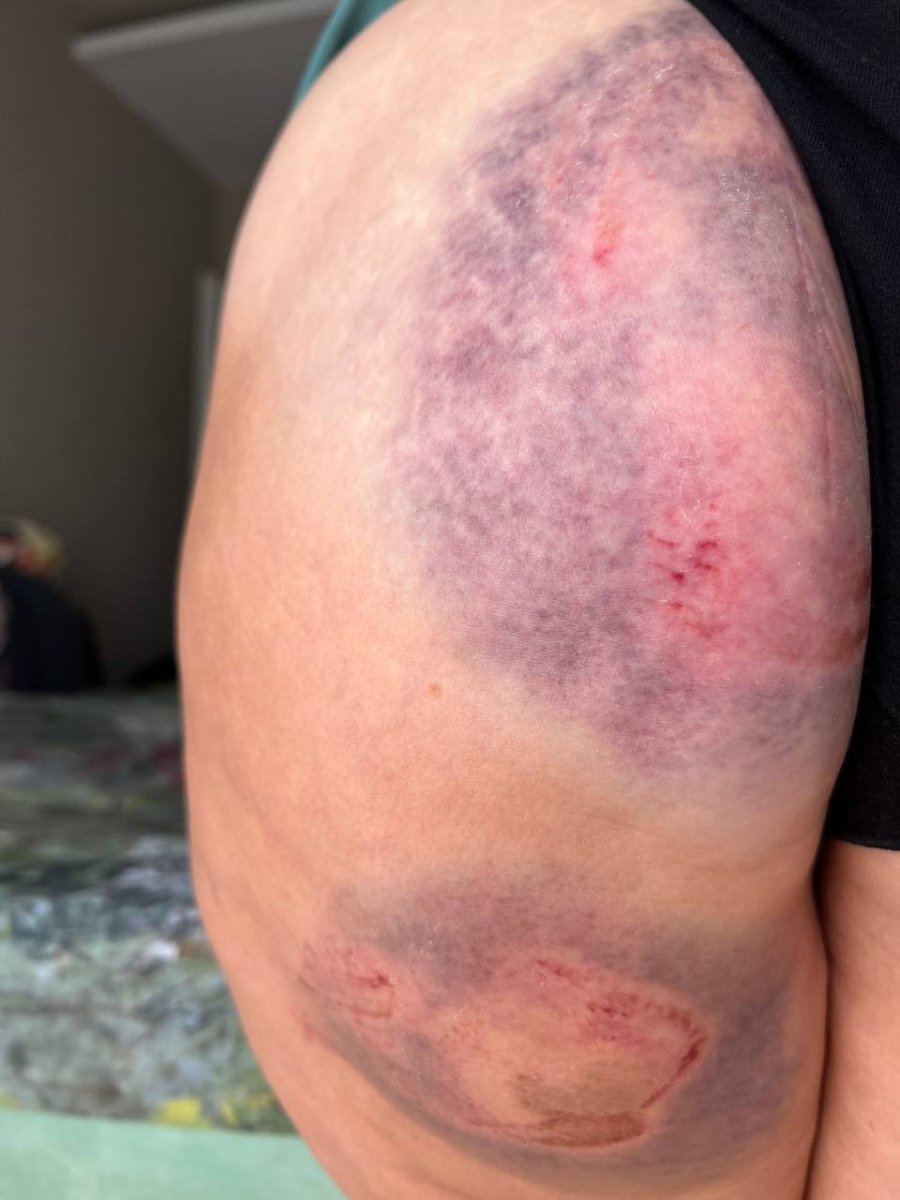 Denizde Caretta Carettanın Saldırısına Uğrayan Rus Kadın Yaralandı