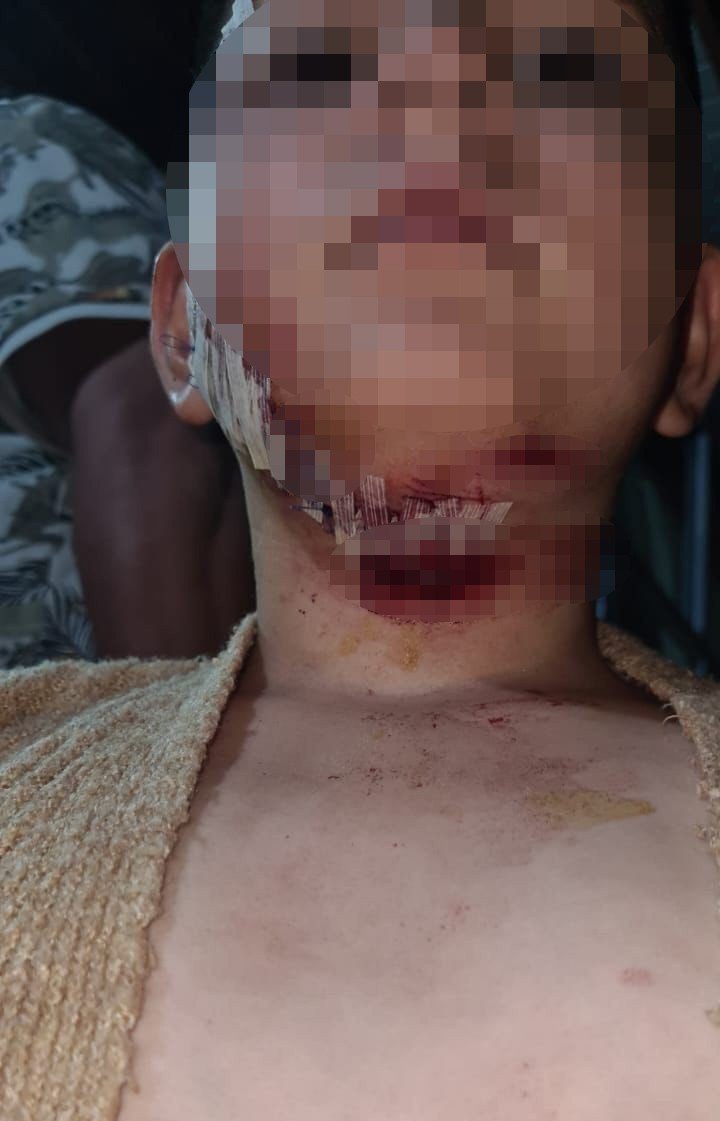 Köpeğin Saldırdığı Çocuk Hastanelik Oldu