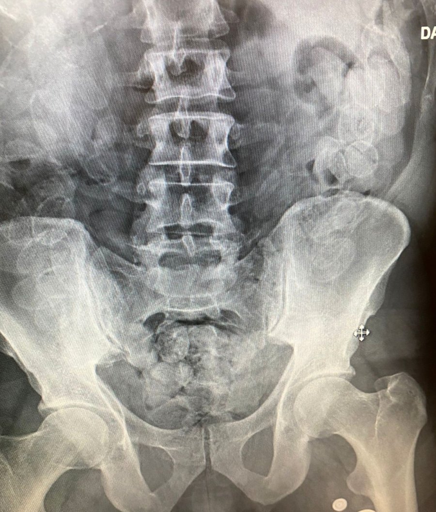 Fas Uyruklu Yolcunun Midesinde 100 Kapsül Macun Esrar Yakalandı