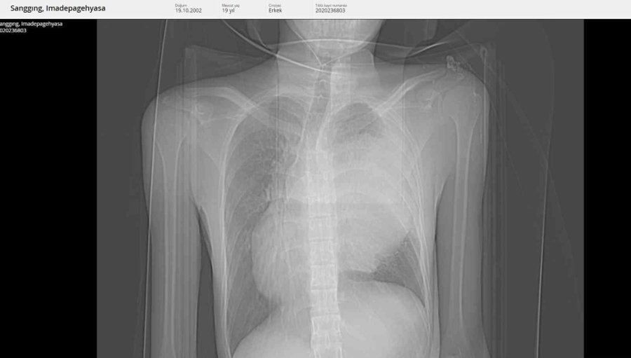 Endonezyalı Gencin Göğsünden 3 Kilogramlık Kitle Çıkarıldı