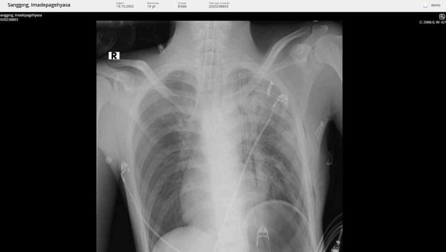 Endonezyalı Gencin Göğsünden 3 Kilogramlık Kitle Çıkarıldı
