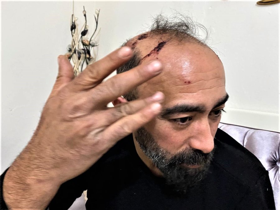 Müşterinin Kaldırım Taşı İle Dehşeti Yaşattığı Taksici: "kaç Defa Vurdu Sayamadım"