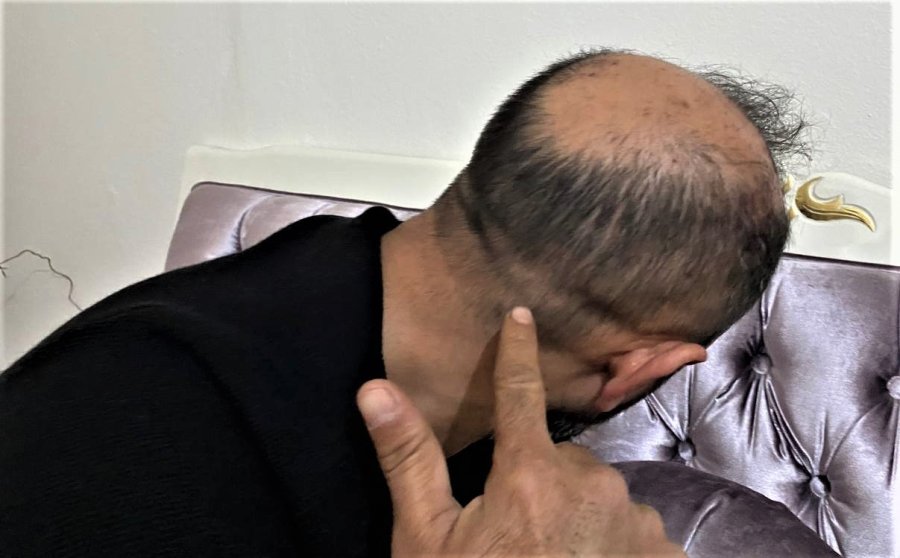 Müşterinin Kaldırım Taşı İle Dehşeti Yaşattığı Taksici: "kaç Defa Vurdu Sayamadım"