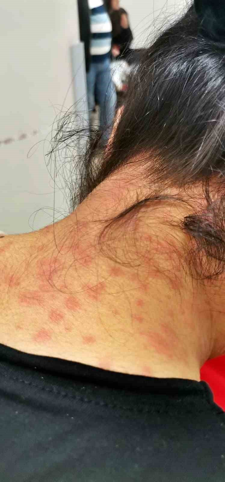 Evinin Bahçesindeki Tırtılları Süpürdü, Hastanelik Oldu