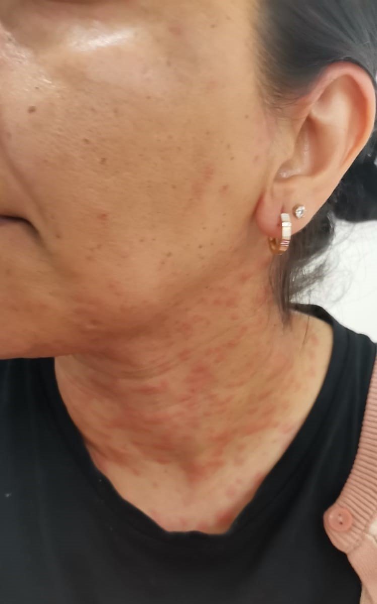 Evinin Bahçesindeki Tırtılları Süpürdü, Hastanelik Oldu