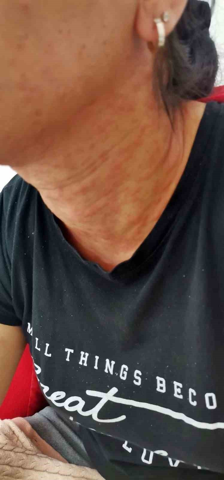 Evinin Bahçesindeki Tırtılları Süpürdü, Hastanelik Oldu