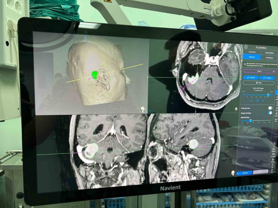 Niğde’de İlk Köşe Tümörü Ameliyatı Başarıyla Gerçekleştirildi