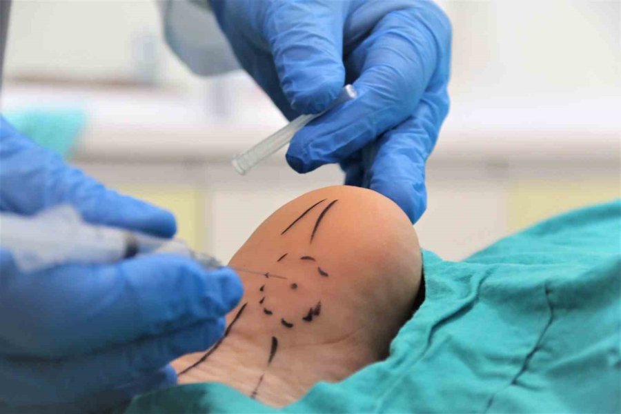 Topuk Dikenine Tek Doz Botoks İle Dakikalar İçerisinde Çözüm