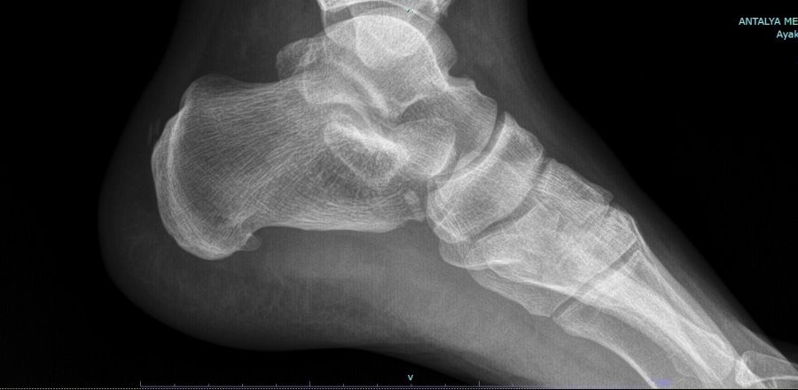 Topuk Dikenine Tek Doz Botoks İle Dakikalar İçerisinde Çözüm